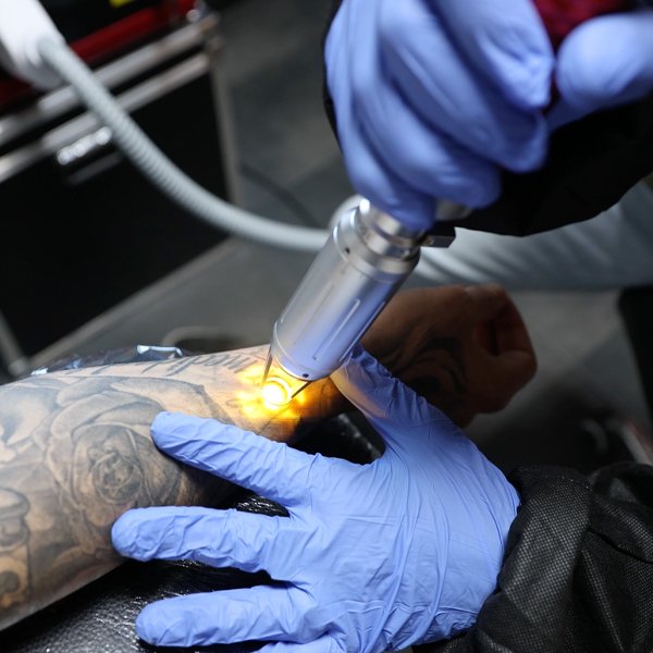 Remoção Tatuagem